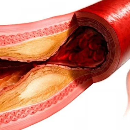 Aortaň we magistral arteri&yacute;alaryň aterosklerozy
